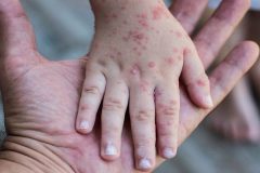 سرخک یک بیماری ویروسی و بسیار مسری/ تا کنون موردی در استان مرکزی مشاهده نشده